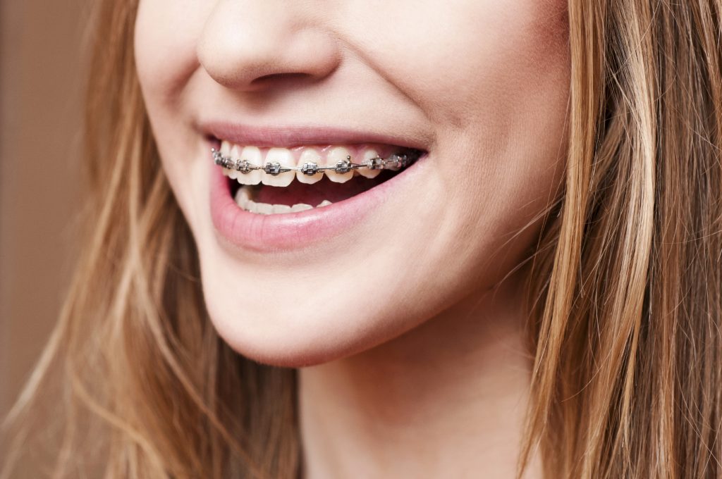 Braces and Your Oral Health – The Grove Family Dentistry