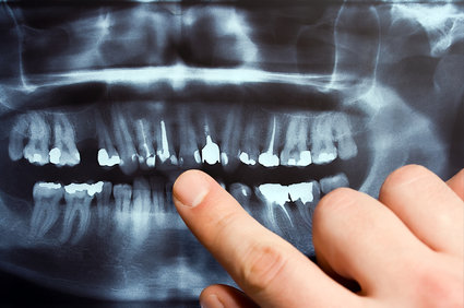 Five Reasons to Get Dental X-Rays