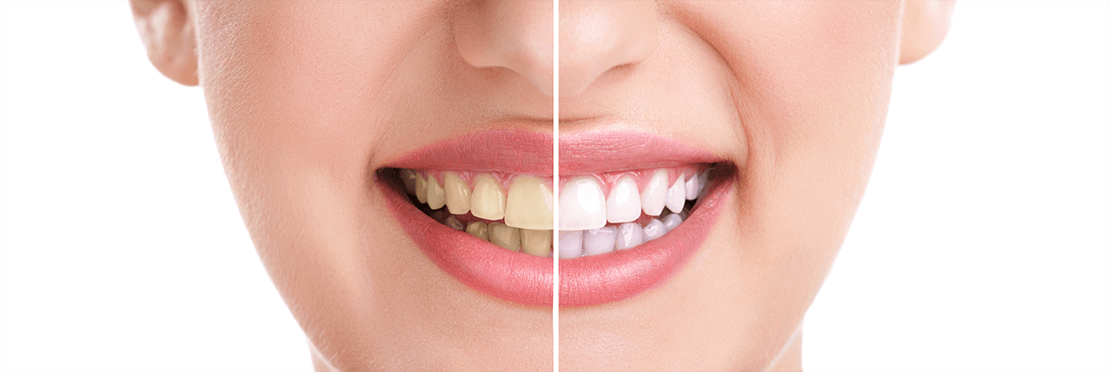 Teeth Whitening in Clayton, California